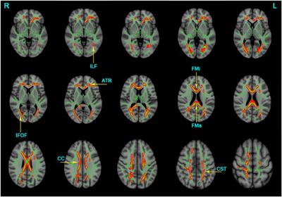 Long Longitudinal Tract Lesion Contributes to the Progression of Alzheimer's Disease